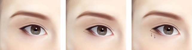 下眼瞼拡大術の特徴