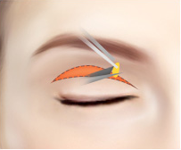 上眼瞼手術の流れ