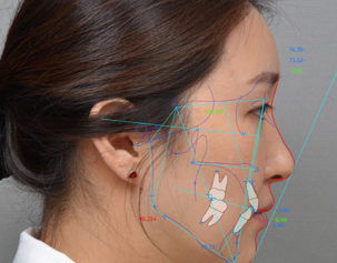 3D CTを基に付いて口腔外科専門医との精密な診断とカウンセリングOrthovision過程